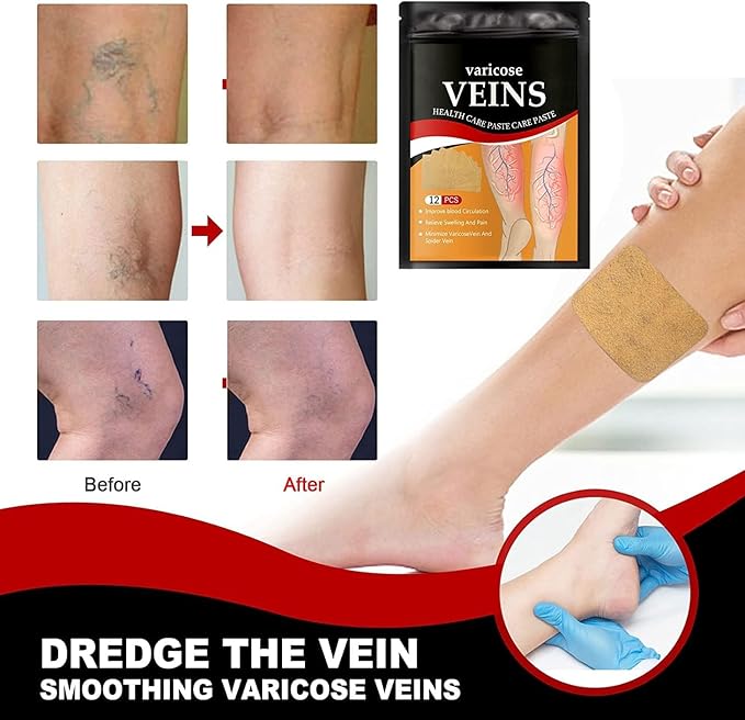 Varicose Vein Treatment Patches – 12 PCS Spider Vein Remover for Legs – Soothing & Effective Varicose Veins Relief Patches